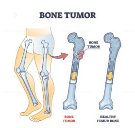 Bone tumor as abdominal tissue growth on human skeleton outline diagram