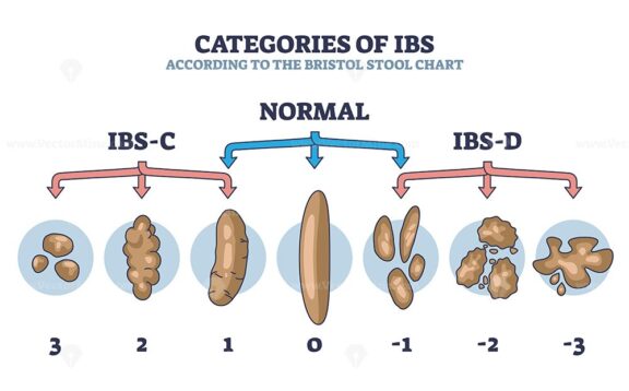 Categories of IBS stages according to bristol stool chart outline diagram