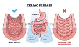 Celiac disease as chronic digestive and immune disorder outline diagram