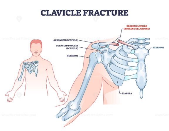 Clavicle fracture anatomy and broken shoulder collarbone outline diagram