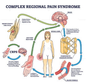 Complex regional pain syndrome or CRPS as painful condition outline diagram
