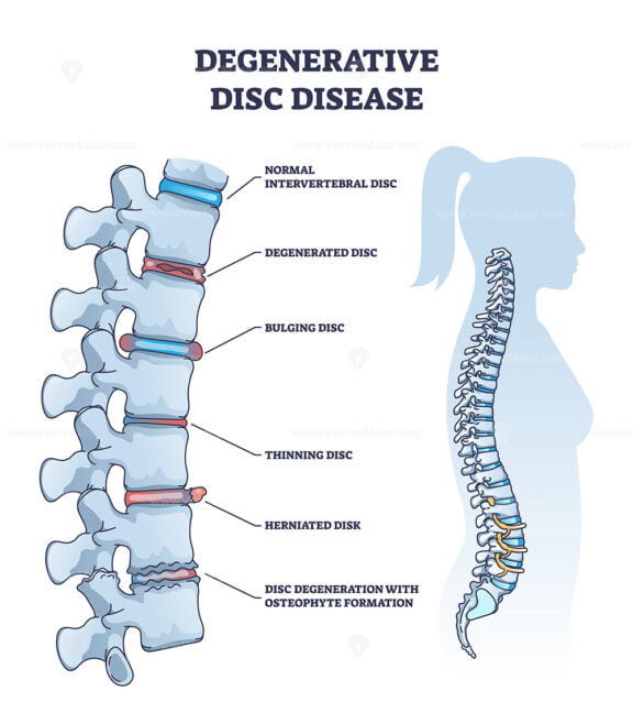 Degenerative disc disease with spine and vertebra trauma outline diagram