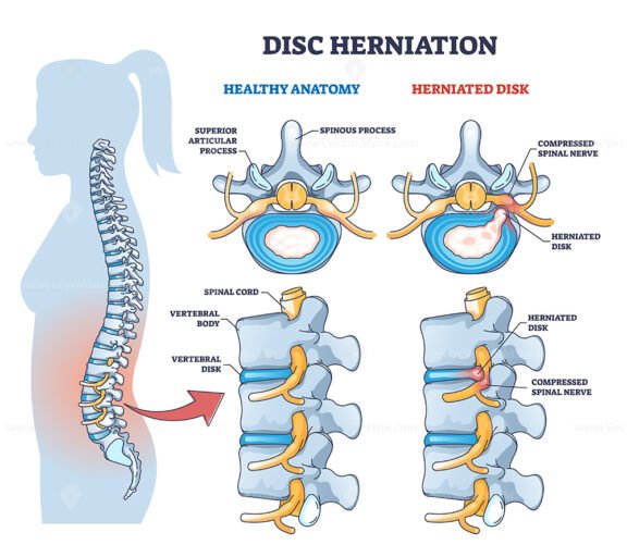 Disc herniation or spine nerve compression vs healthy anatomy outline diagram