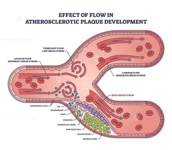 Effect of flow in atherosclerotic plaque development outline diagram