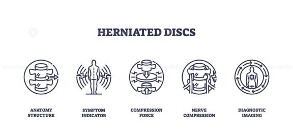 Herniated discs are illustrated with outline icons showing anatomy, symptoms, and compression. Outline icons set.
