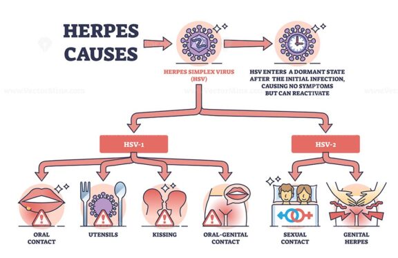 Herpes causes and medical skin HSV virus transmission outline diagram.