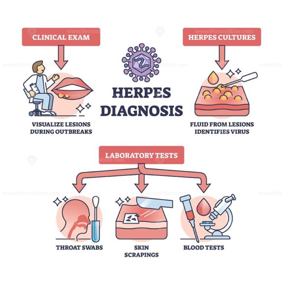 Herpes diagnosis and HSV virus medical diagnosis methods outline diagram