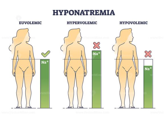 Hyponatremia body condition with low sodium salt level outline diagram