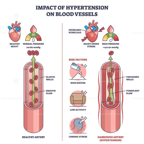Impact of hypertension on blood vessels with high pressure outline diagram