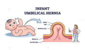 Infant umbilical hernia as painless lump near belly button outline diagram