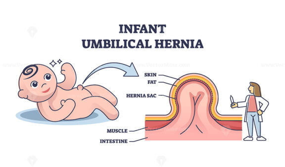 Infant umbilical hernia as painless lump near belly button outline diagram