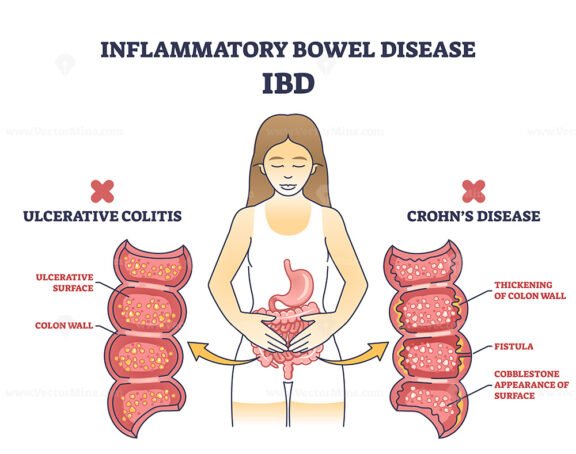 Inflammatory bowel disease or IBD with Crohns and colitis outline diagram