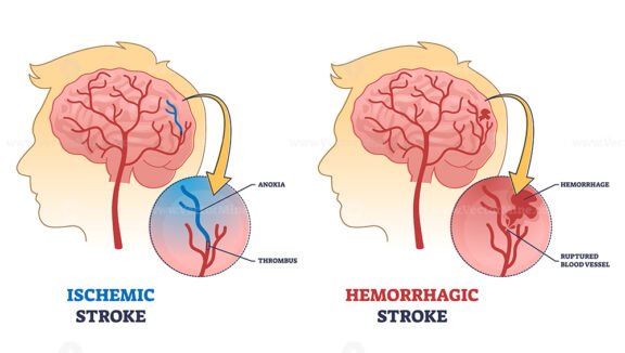 Ischemic vs hemorrhagic head stroke anatomical comparison outline diagram