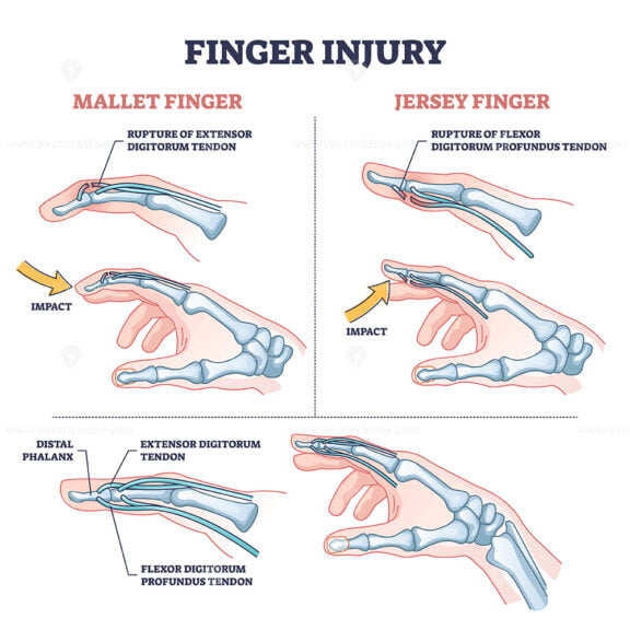 Finger injury types with common hand impact trauma anatomy outline diagram
