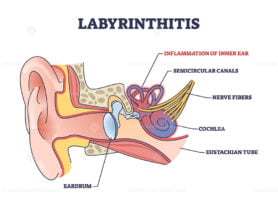 Labyrinthitis as inner ear infection and medical inflammation outline diagram