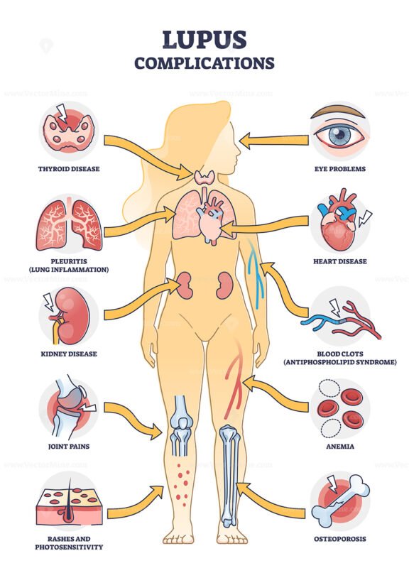 Lupus erythematosus medical autoimmune disease complications outline diagram
