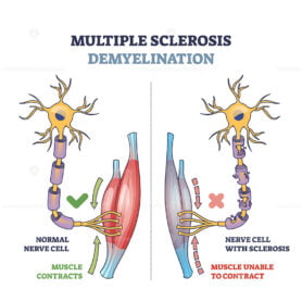 Multiple sclerosis demyelination compared with healthy nerves outline diagram