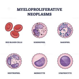 Myeloproliferative neoplasms as bone marrow blood diseases outline diagram