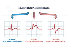 Electrocardiogram STEMI and NSTEMI abnormal heart rate outline diagram