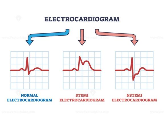 Electrocardiogram STEMI and NSTEMI abnormal heart rate outline diagram