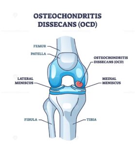 Osteochondritis dissecans or OCD bone and cartilage condition outline diagram
