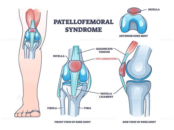 Patellofemoral pain syndrome with anatomical knee condition outline diagram