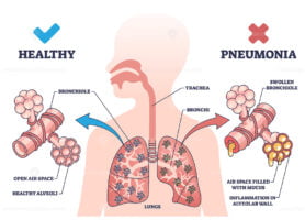 Pneumonia illness medical comparison with healthy lungs outline diagram