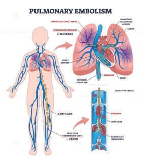 Pulmonary embolism diagram shows a blood clot blocking a lung artery, highlighting embolus, lungs, and blood vessels. Outline diagram