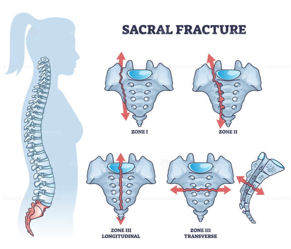 Sacral fracture with backbone skeletal trauma or injury types outline diagram