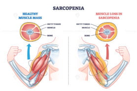 Sarcopenia as muscle mass loss and fatty tissue growth outline diagram