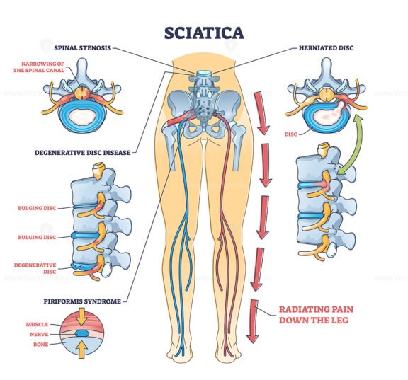 Sciatica pain or nerve weakness as leg lumbar radiculopathy outline diagram