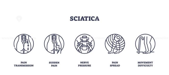 Sciatica icons outline key concepts like pain transmission, nerve pressure, and movement difficulty. Outline icons set.