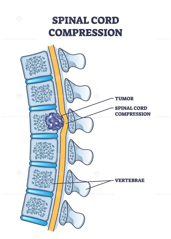 Spinal cord compression with tumor and vertebrae condition outline diagram