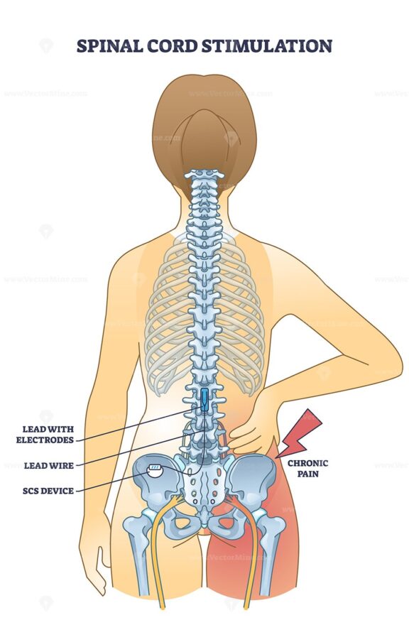 Spinal cord stimulation device for chronic back pain relief outline diagram