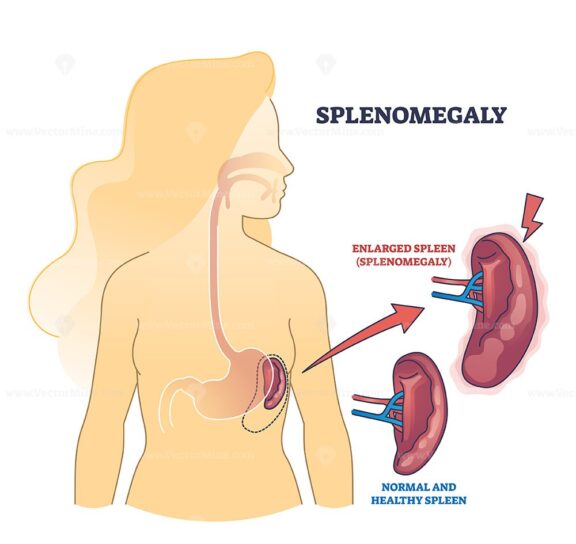 Splenomegaly symptom as enlarged spleen vs healthy organ outline diagram