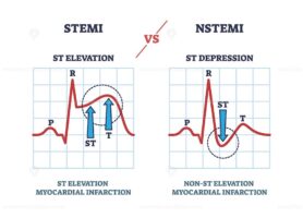 STEMI vs NSTEM heart beat impulse in cardio visualization outline diagram
