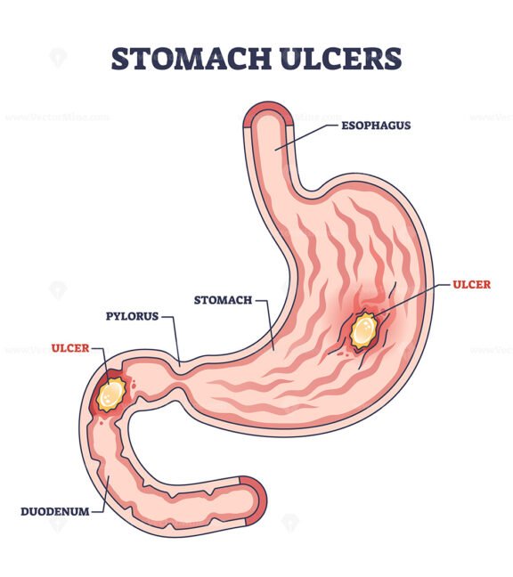 Stomach ulcer as chronic gastric problem with burning pain outline diagram