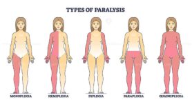 Types of paralysis and limb body parts as medical condition outline diagram