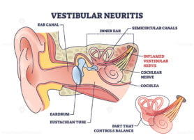 Vestibular neuritis as inner ear nerve inflammation disease outline diagram